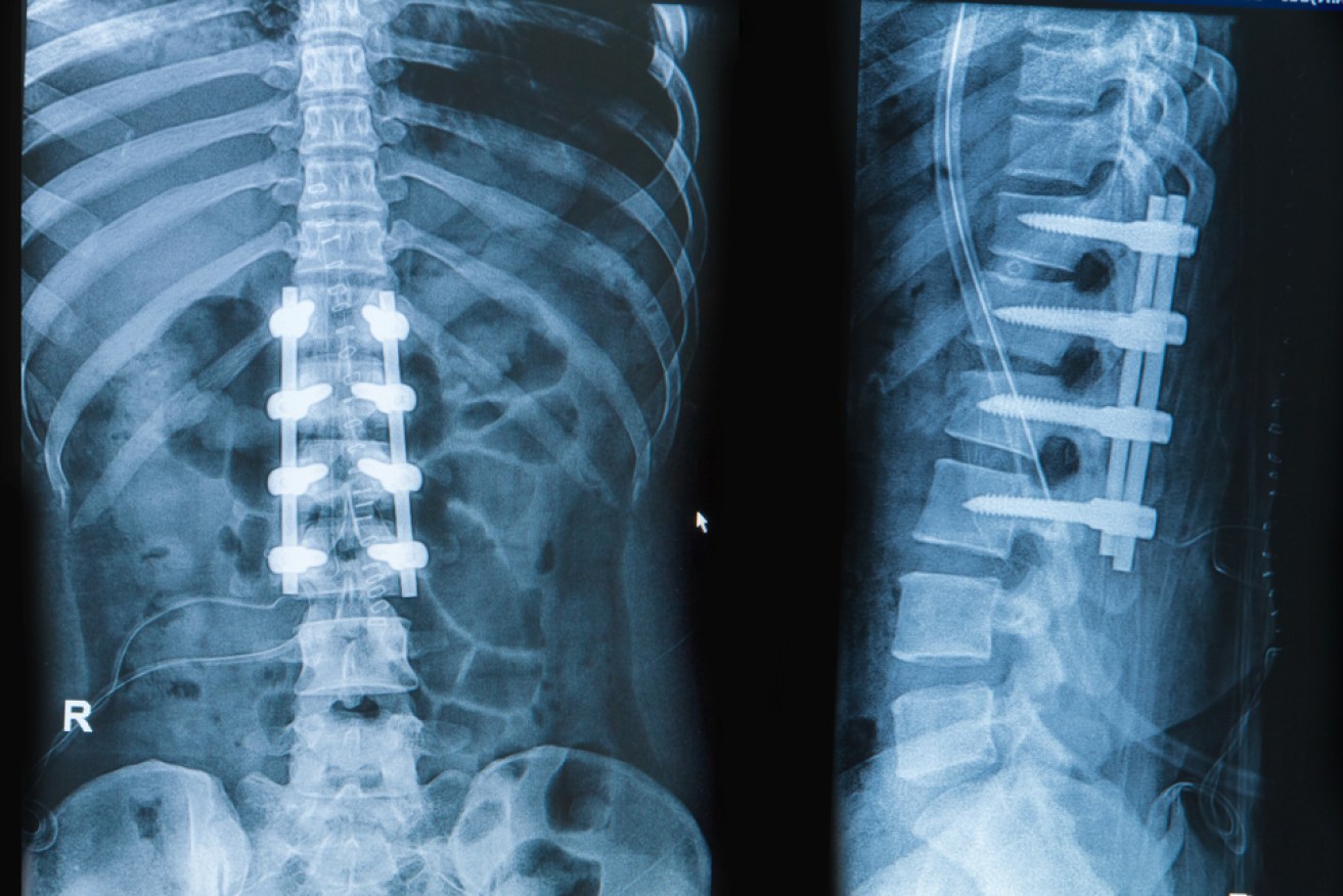 Flinders University's MDPP will design and prototype an instrument to enable bone graft delivery during minimally invasive spinal fusion procedures. Picture: Shutterstock. 