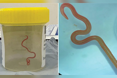 Snake parasite found in woman’s brain